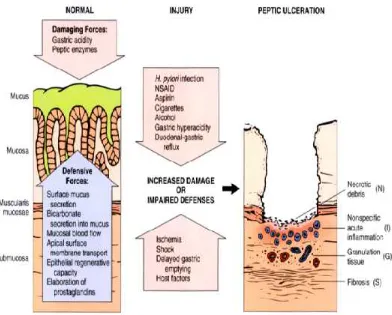 Fig.03: Peptic ulcer of duodenum