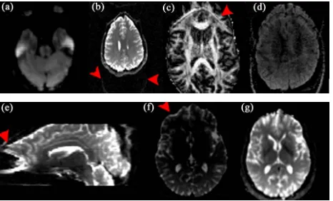 Figure 4. Examples of DWI artifacts. (a) T2-shine-through. (b), (c), (d) Ghosting artifacts