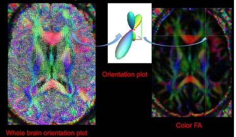 Figure 5. Whole brain diffusion orientation plots (left) using constrained spherical reconstruction to demonstrate fiber crossing at each voxel (middle), and its spatial location shown by color FA image (right)