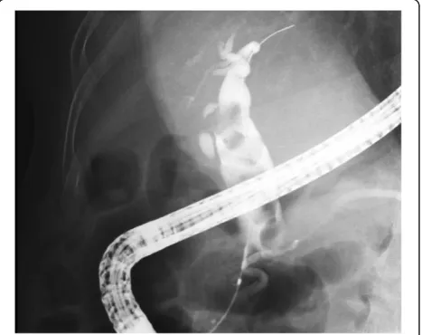 Fig. 1 Cholangiogram showing multiple large stones. After thecommon bile duct was selectively imaged using endoscopicretrograde cholangiography, the sizes and number of stones wereconfirmed, and the diameter of the distal bile duct was measuredsimultaneously