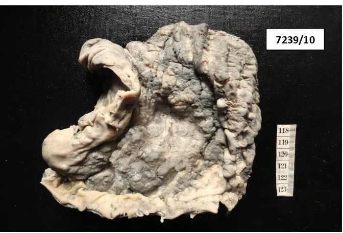 FIGURE 7 : Gastric adenocarcinoma (IT) – Ulcerative, infiltrative 