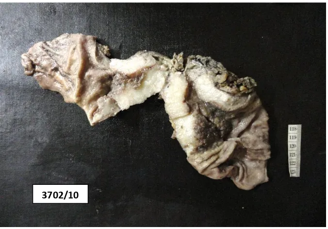 FIGURE 9 : Gastric adenocarcinoma (DT) – Linitis Plastica 