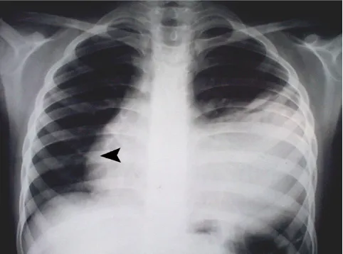 Figure 1owed the left border of the heartmass in anterolateral part of left lung which had overshad-The PA chest X-ray: left-sided pleural effusion and a large The PA chest X-ray: left-sided pleural effusion and a large mass in anterolateral part of left l
