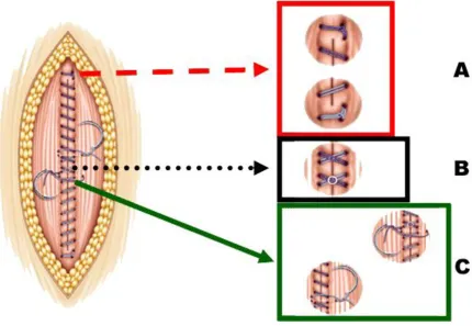 Figure 1Principles of continuous abdominal wall closurePrinciples of continuous abdominal wall closure