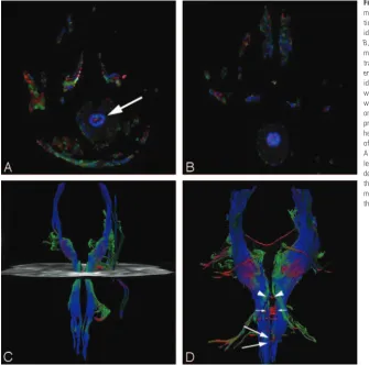 Table 2: Structural MR and diffusion tensor imaging findings in six patients with Joubert syndrome
