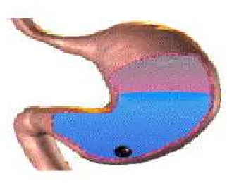 Fig: 8 Graphic of heavy tablet which is denser than the stomach fluid and 