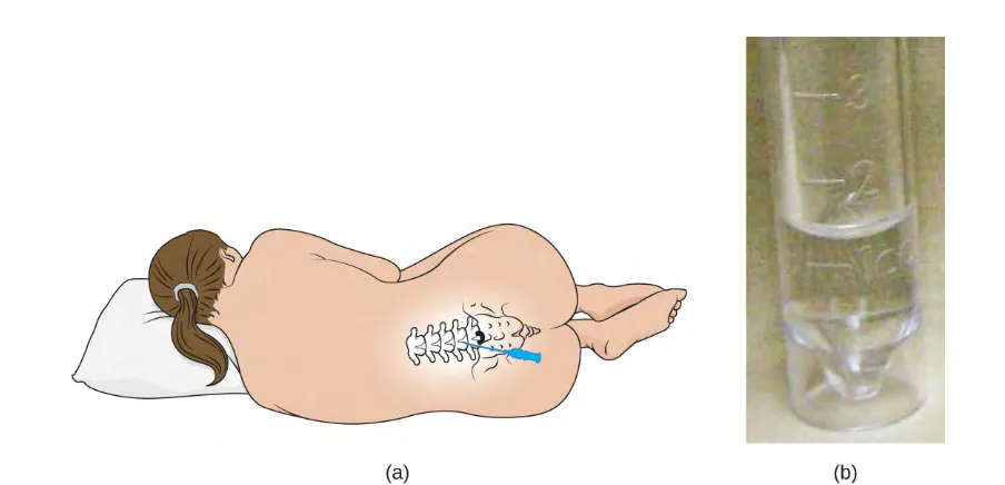 Figure 1.2 (a) A lumbar puncture is used to take a sample of a patient’s cerebrospinal fluid (CSF) for testing.A needle is inserted between two vertebrae of the lower back, called the lumbar region