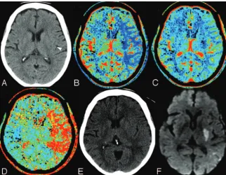 Fig 1. A 75-year-old man, within 2 hours of right-sided strokeand presentation of NIHSS 20