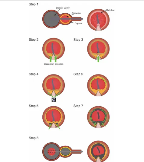 Fig. 1 Illustration of the thulium laser prostate enucleation (ThuLEP) surgical technique