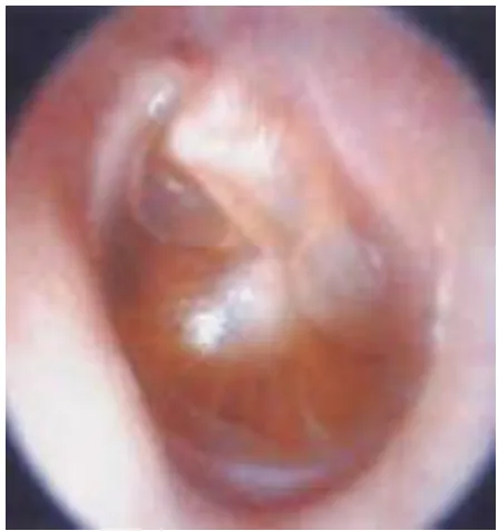 Figure.4: Acute suppurative otitis media 