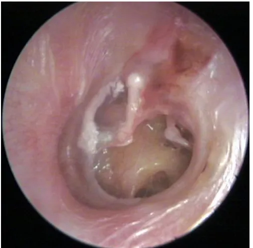 Figure.7 Infected fluid in the middle ear 