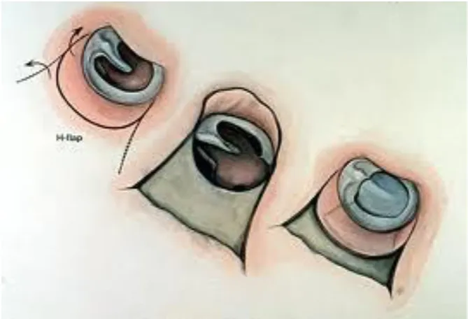 Figure.9: Myringoplasty 