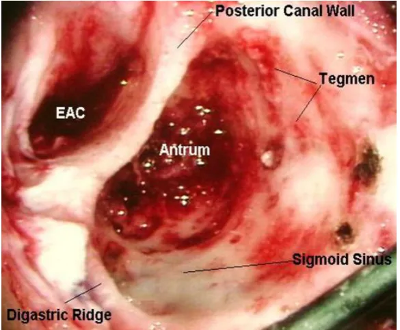 Figure.10: Cortical mastoidectomy 