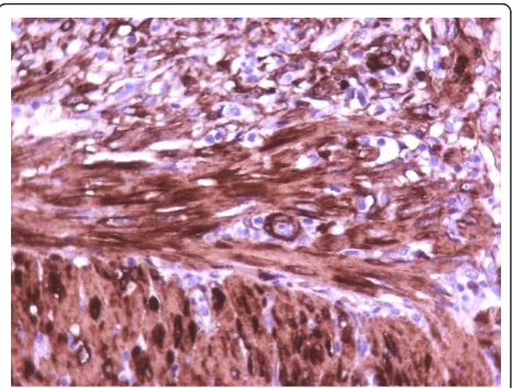 Figure 4 Bigger magnification of the anastomotic site (7thpostoperative day) (immunohistochemical stains for a-SMA,×400).