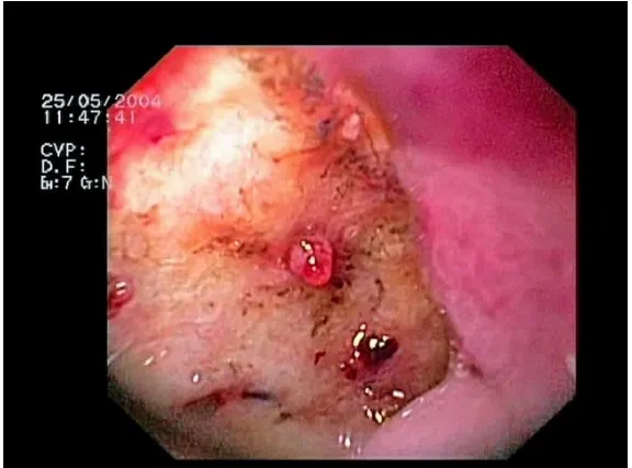 Figure 2. Ulcer 
