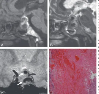 Fig 1. Patient 1. A 65-year-old woman presented with classicsmall amount of chromophobic adenoma (H&E, originalmagnificationpituitary apoplexy manifesting as a sudden onset of severeheadache, nausea, vomiting, and visual disturbance