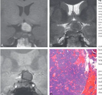 Fig 2. Patient 2. A 30-year-old man presented with subacutegraph showing hemorrhage in chromophobic adenoma (H&E,original magnificationweighted MR image showing a large pituitary lesion con-taining a large area of high signal intensity.T2-weighted MR image