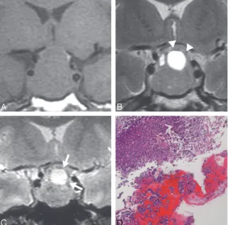 Fig 3. Patient 3. A 43-year-old man had typical cysts in ashowing the faint hypointense rim of a cyst (nonfunctioning adenoma