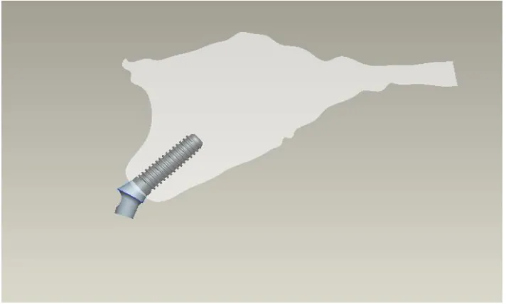 Figure:1 Maxilla Bone Model 