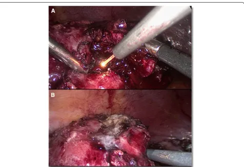 Fig. 1 Surgical steps. a, Laser enucleation of the tumor. b, The tumor bed after enucleation and coagulation with the 1318-nm diode laser
