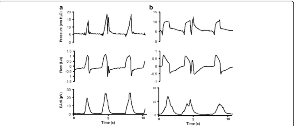 Fig. 3 Tracings for Airway Pressure, Flow, and Electric Activity of the Diaphragm (EAdi) showing double-triggering in Neurally Adjusted VentilatoryAssist (NAVA) and Pressure Support Ventilation (PSV)