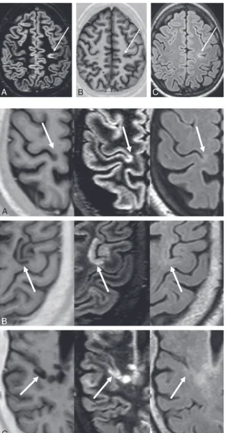 Fig 1. DIR (A), PSIR (B), and FLAIR (C) images from a single
