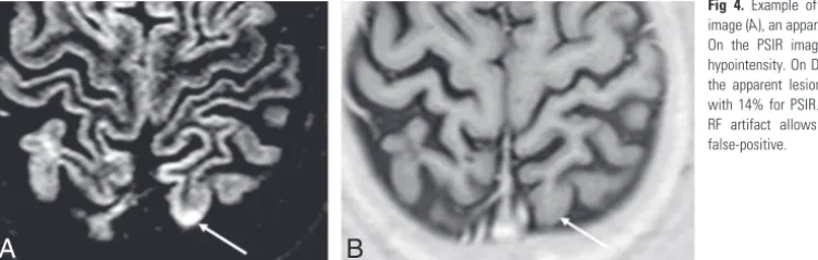 Fig 4. Example of RF inhomogeneity artifact. On the DIRimage (A), an apparent cortical lesion is visible (white arrow).On the PSIR image (B), there is again no correspondinghypointensity