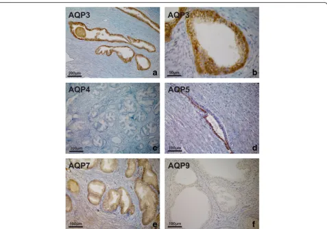 Fig. 3 AQP immunoperoxidase labelling of non-malignant prostatic tissues (BPH). Intense expression of AQP 3 throughout the epithelium from aHeterogeneous expression of AQP 5 (patient with BPH