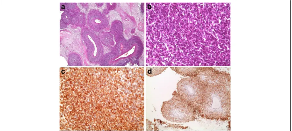Fig. 1 Partially necrotic, densely cellular proliferation with a prominent perivascular growth pattern (spindle in appearance (a, H&E stain, 40×)