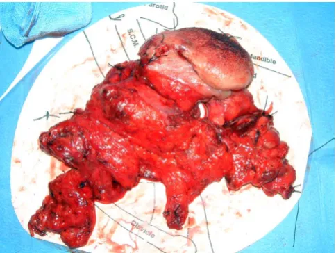 Figure 3A Modified radical neck dissection specimenA Modified radical neck dissection specimen