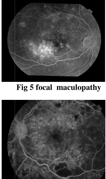 Fig 5 focal  maculopathy 