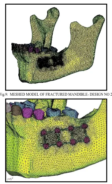 Fig.10:  MESHED  MANDIBLE WITH 3-D MINIPLATE - DESIGN NO 2