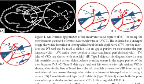 Figure 1. (A) Normal appearance of the interventricular septum (IVS) (including the membranous part) and left ventricular outflow tract (LVOT)