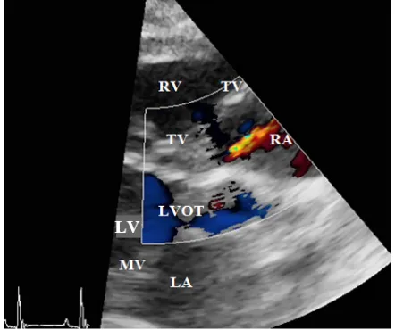 Figure 4. (A) Modified right parasternal long axis view at the level of left ventricular outflow tract showing the pres-ence of a ventricular septal defect (arrow) between the left ventricle and right atrium