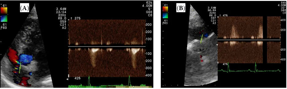 Figure 6. (A) Continuous wave Doppler of the left-to-right ventricular septal defect in a modified right parasternal long axis view at the level of the left ventricular outflow tract