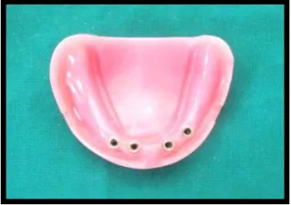 Fig.19a: Edendulous model former       Fig.19b: Edentulous wax model                                                                            