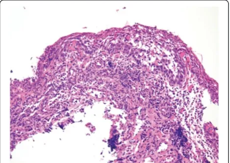 Figure 9 Histologic diagnosis of a resected specimen wascancer in situ.