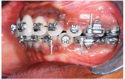 Figure (4). CASE OF SELF-LIGATING BRACKET SYSTEM