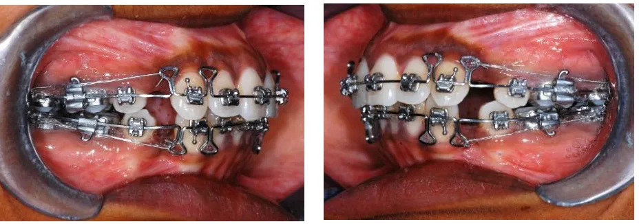 Figure (5). RETRACTION WITH SUZUKI TIE 