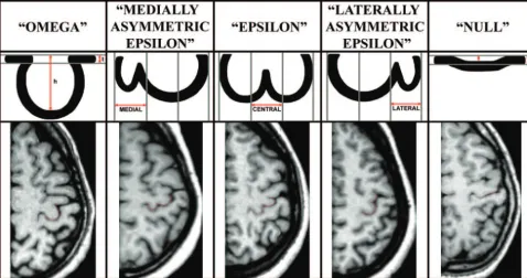 Fig 1. Schematic representation of the criteria used for morphologic classification and corresponding MR image of a typical example