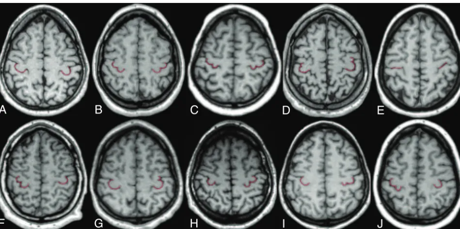 Fig 2. Multiplanar reformatted axial sections obtained 50epsilon-medially asymmetric epsilon.are representative examples of the different combinations of HMC morphologic variants (red highlight) in the 2 hemispheres:I � 2 mm above the Talairach anterior AC