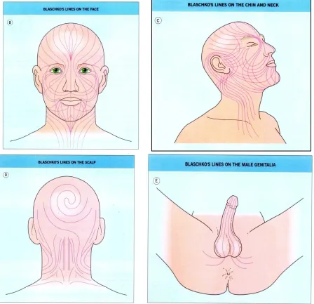 FIGURE 3: DISTRIBUTION PATTERN OF BLASCHKO’S – HEAD, NECK & GENITALS 