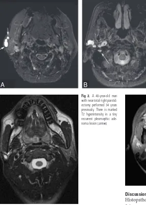 Fig 1. Ahyperintense recurrent lesions at the right stylomastoidforamen (, 55-year-old woman who underwent superficialparotidectomy 22 years before recurrence