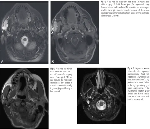 Fig 4. A 55-year-old man with recurrence 35 years afterdemonstrates a multiloculated T2 hyperintense mass super-ficial to the right masseter muscle (heterogeneous enhancement pattern noted on the postgado-linium image (initial surgery