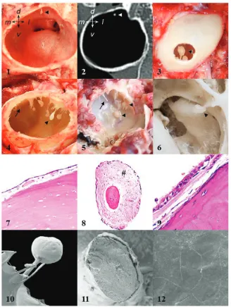 Figure 2. Gross view, computed tomography (CT), histology, and scanning electron microscopy (SEM) of Small Tym-panic Bone Spicules (STBS, arrows) and Hyperostotic Tympanic Bone Spicules (HTBS, arrowheads)