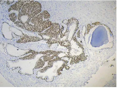 Figure 13:  Benign prostatic hyperplasia showing circumferential proliferation of basal cells