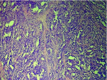 Figure 19: Prostatic adenocarcinoma Gleason pattern 2 –loosely packed single glands with irregular edges