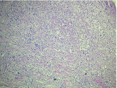 Figure 22: Prostatic adenocarcinoma cells showing prominent nucleoli and mitosis. (H&E 400X) (2674/10) 