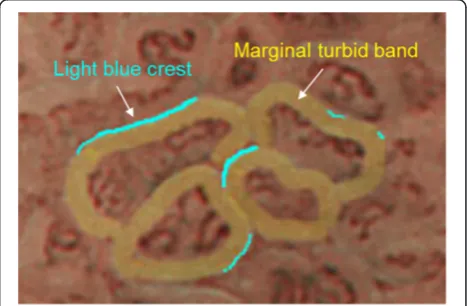 Figure 1 Schematic figure for marginal turbid band and lightblue crest. The marginal turbid band is defined as an enclosing,white turbid band on the epithelial surface/gyri, and light blue crestis defined as a fine, blue-white line on the crest of the epithelialsurface/gyri.