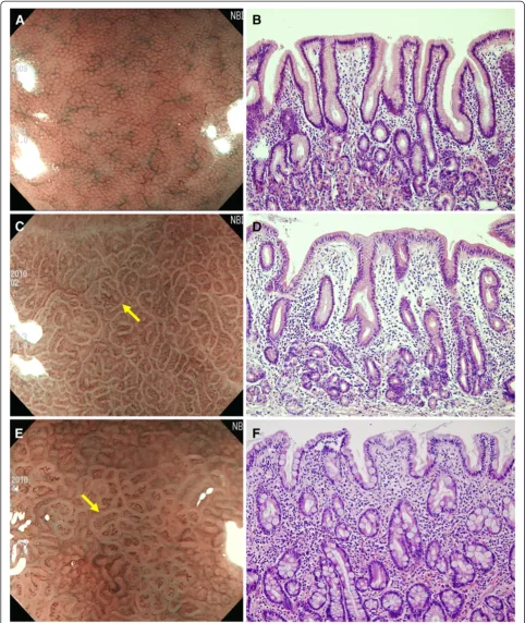 Figure 2 Magnifying NBI endoscopic findings and representative histological findings. Ahoneycomb subepithelial network and a regular arrangement of collecting venules are seen